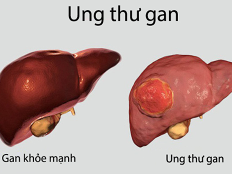 KHOI U O GAN LA GI