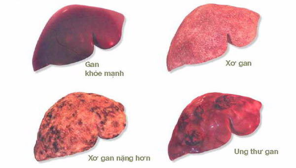 HÌNH ẢNH UNG THƯ GAN GIAI ĐOẠN CUỐI VỚI TỔN THƯƠNG LAN RỘNG VÀ BIẾN DẠNG GAN