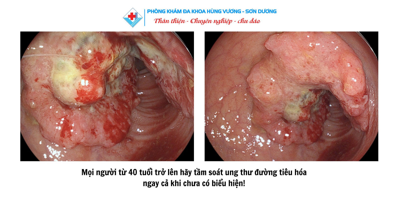 PHIÊN BẢN CẬP NHẬT 2020 CỦA HƯỚNG DẪN UNG THƯ ĐẠI TRỰC TRÀNG
