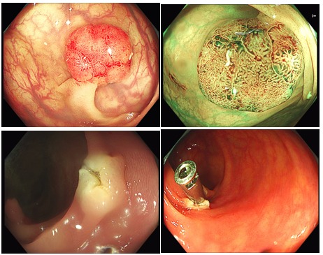 CHI PHÍ CẮT POLYP ĐẠI TRÀNG PHỤ THUỘC VÀO NHIỀU YẾU TỐ Y KHOA KHÁC NHAU